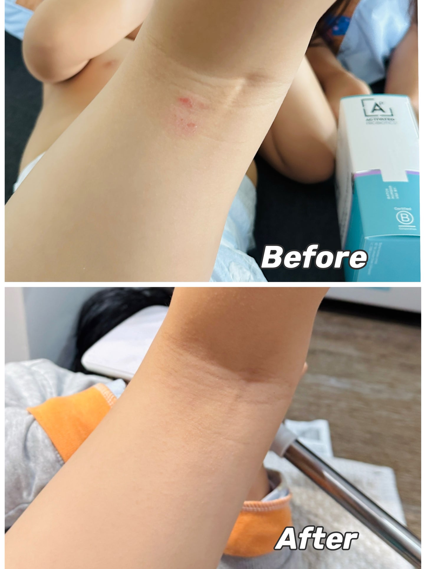 Activated Probiotics 濕疹專用益生菌